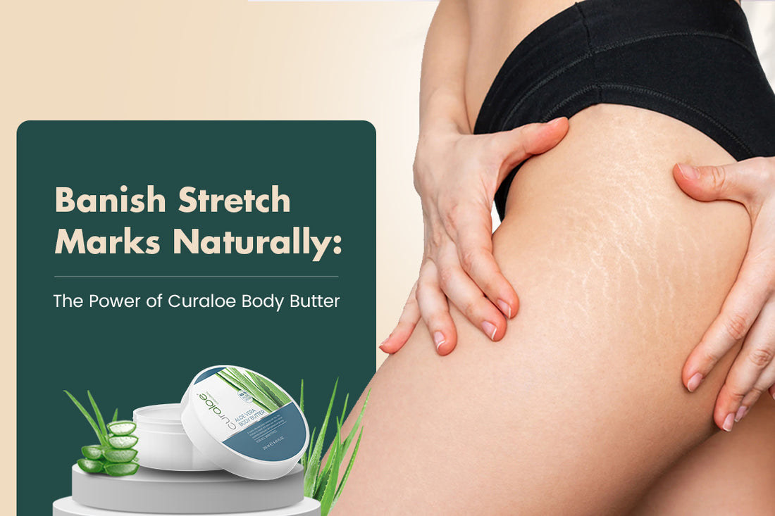 Say Goodbye to Stretch Marks with Curaloe Body Butter