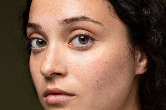 How to Reduce Hyperpigmentation Naturally with Organic Ingredients 